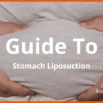 A Guide To Stomach Liposuction In Malaysia (Costs Included)