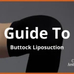 guide-to-buttocks-liposuction-in-malaysia