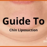 guide to chin liposuction in malaysia including cost