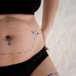 liposuction Malaysia
