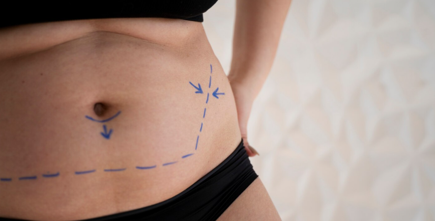 Liposuction Explained: Types, Results, and Safety